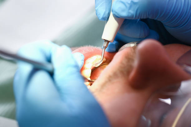 Best Emergency Tooth Extraction in Cairo, GA